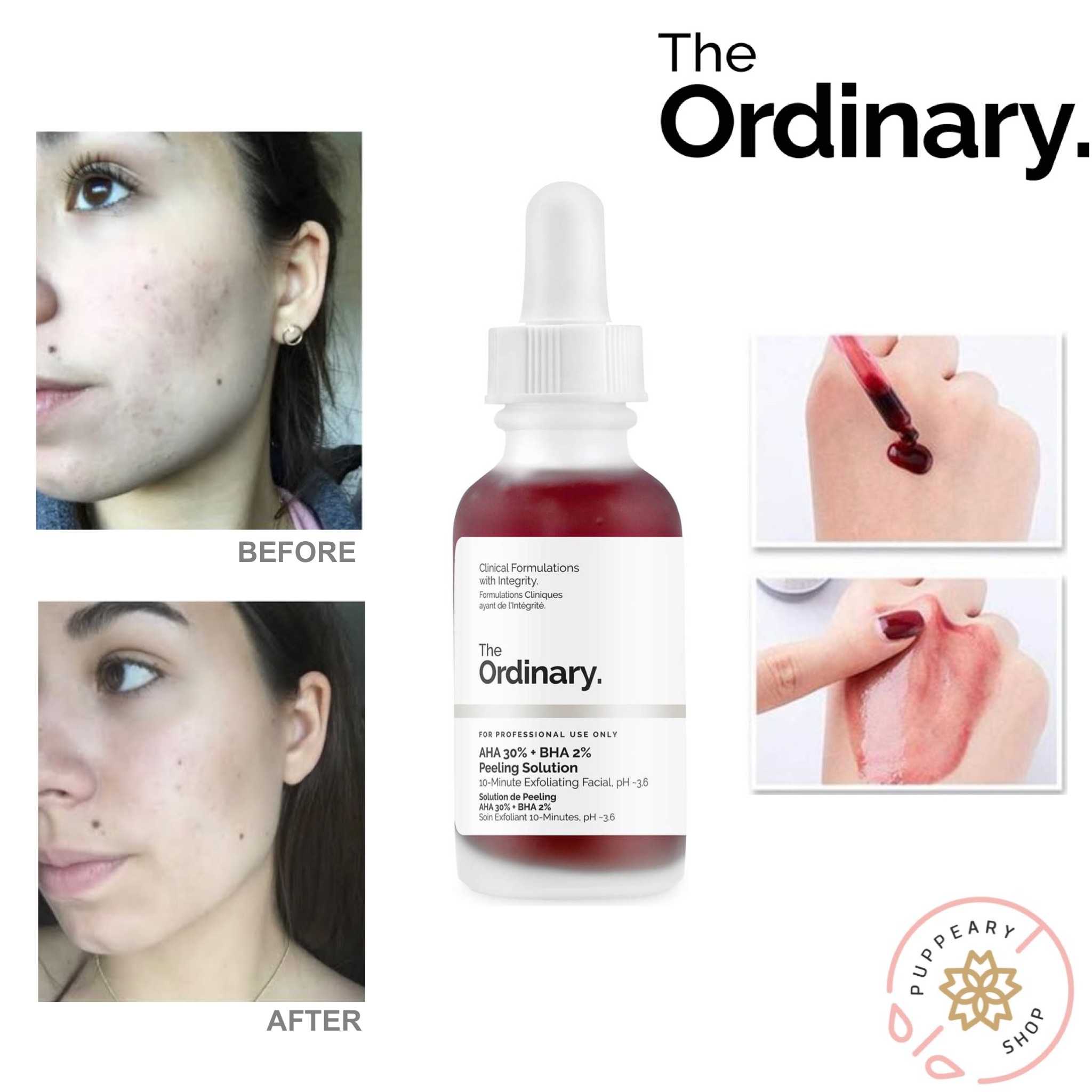 (แท้/พร้อมส่ง) THE ORDINARY AHA 30% + BHA 2% PEELING SOLUTION 30ML