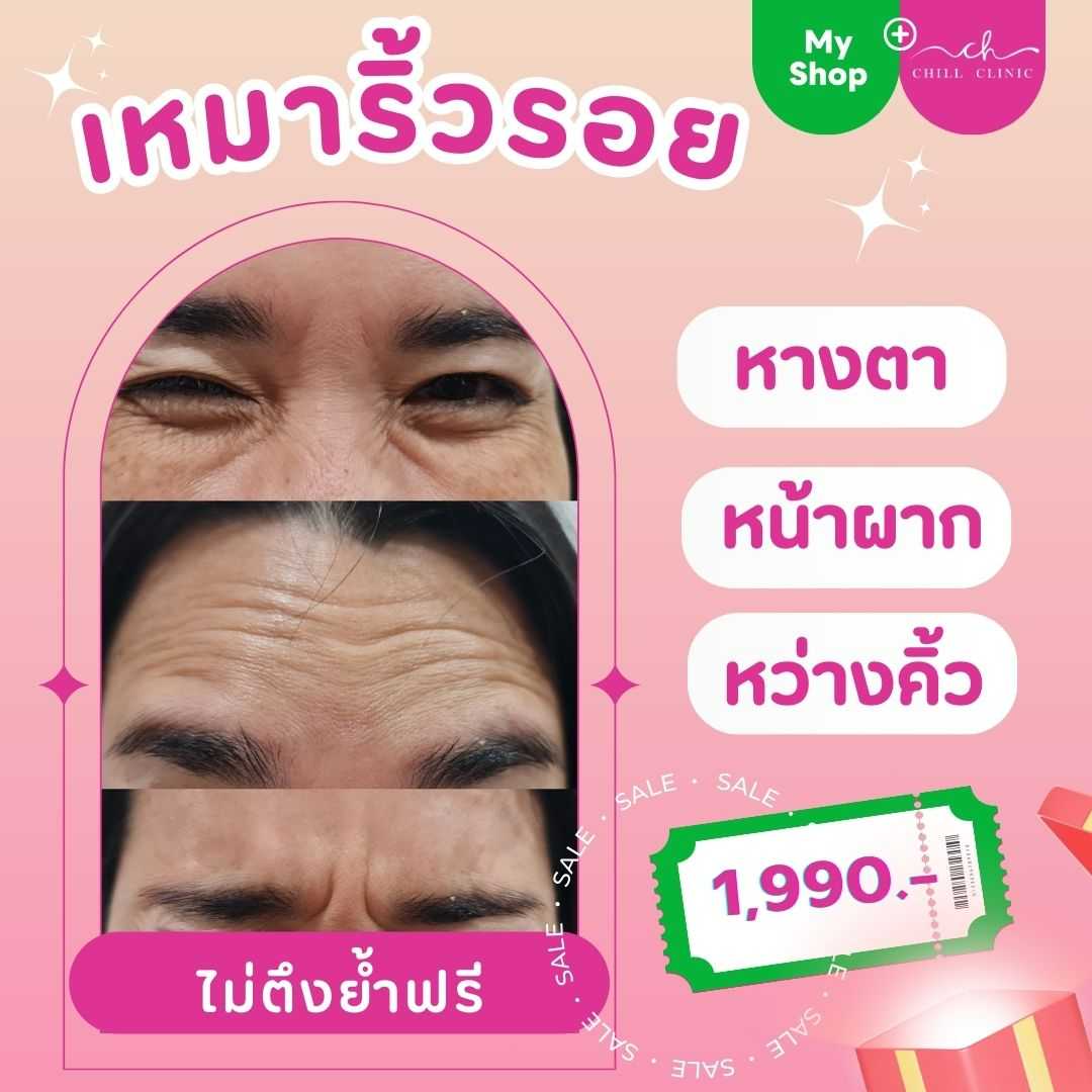 BOTOX NABOTA เหมาริ้วรอย