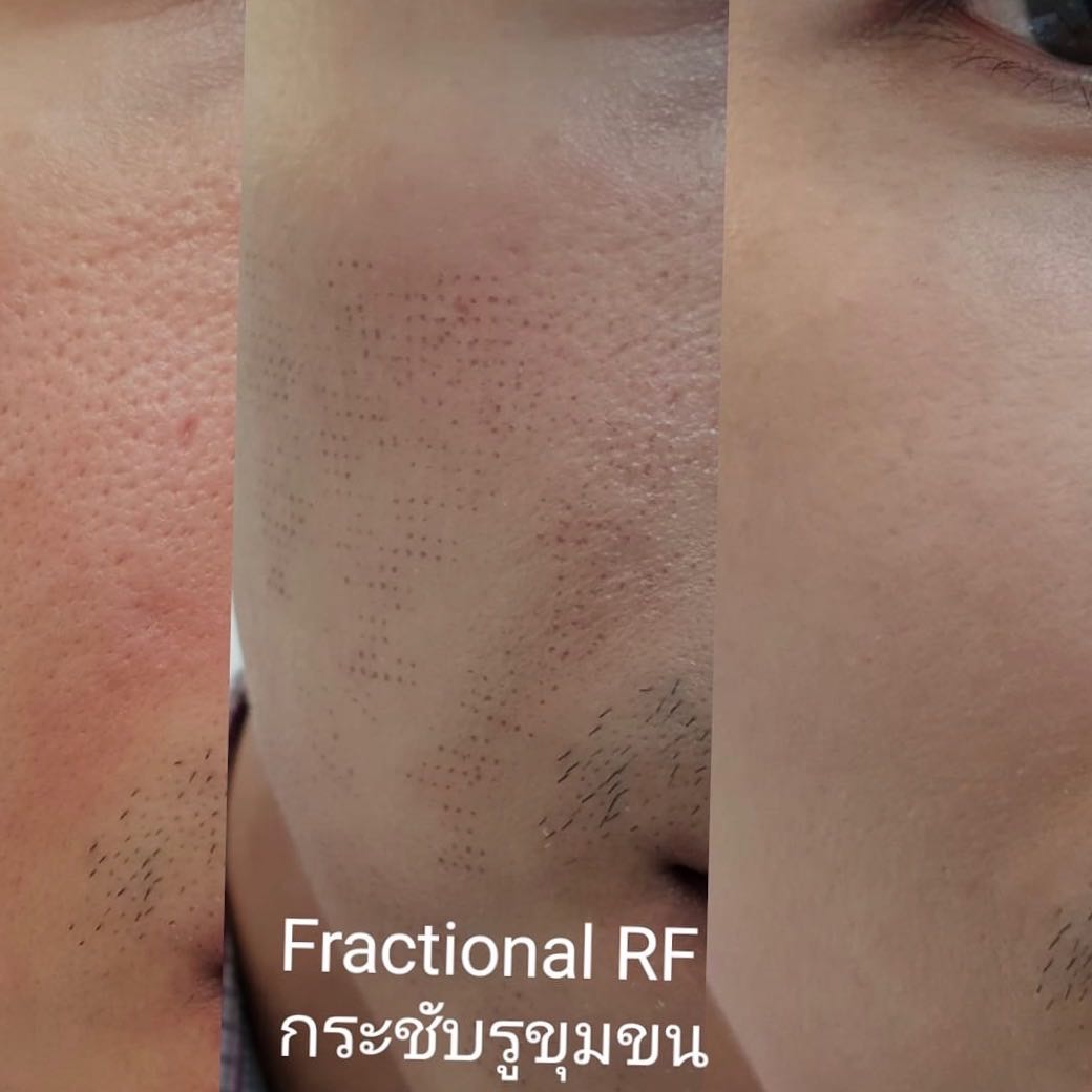 Nano scar laser