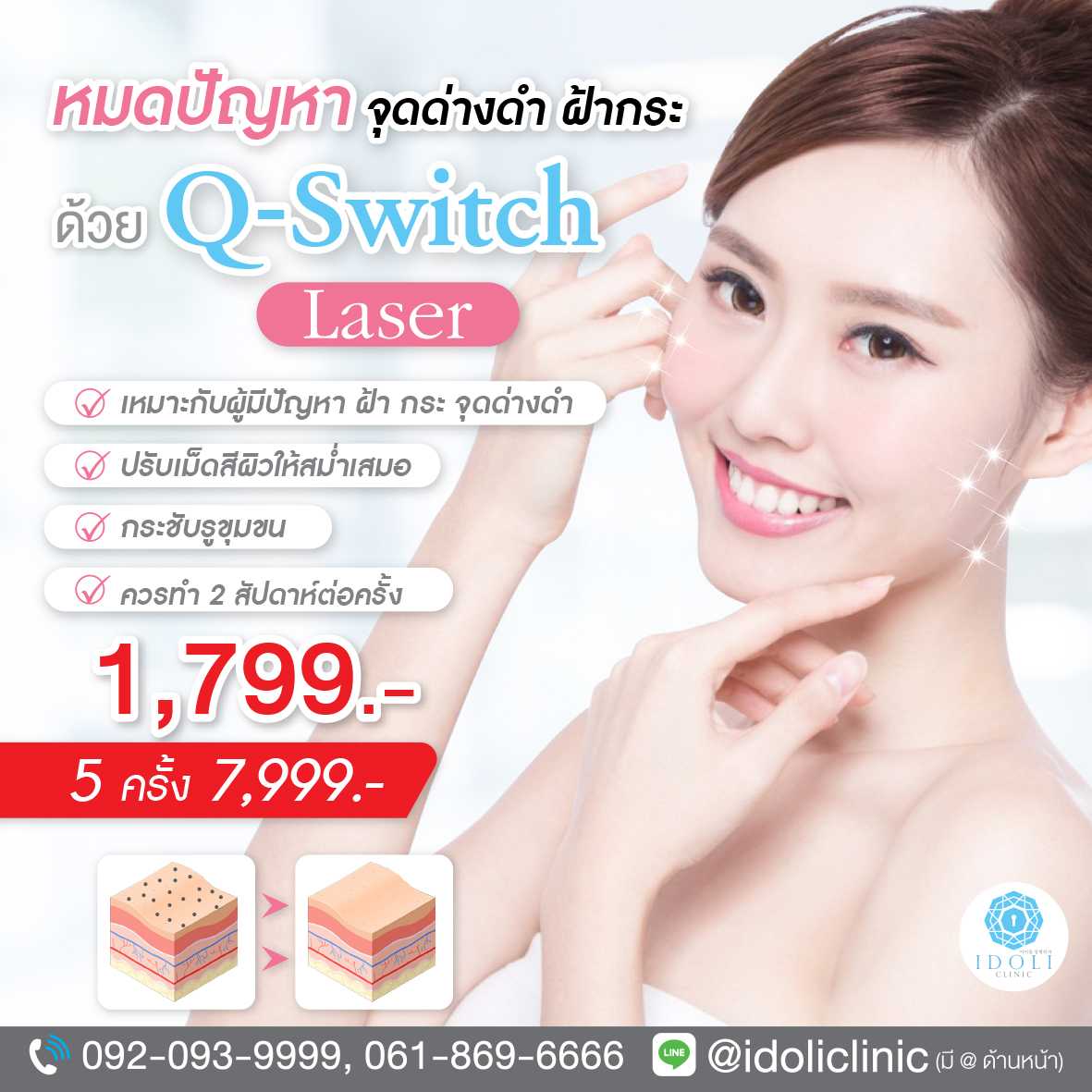 Q-Switch Laser หมดปัญหา จุดด่างดำ ฝ้ากระ