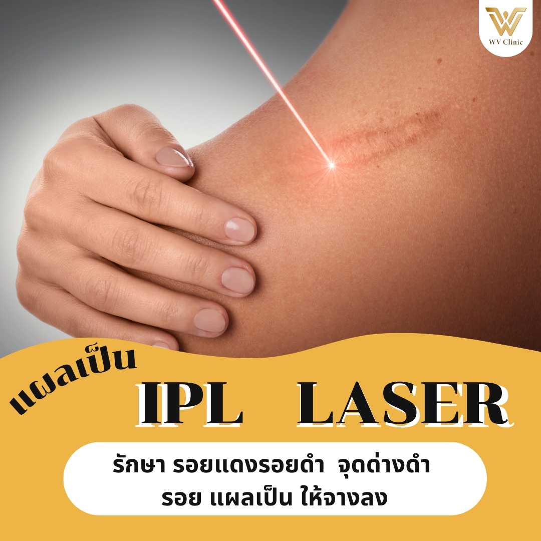 รักษารอยแผลเป็น (IPL LASER)