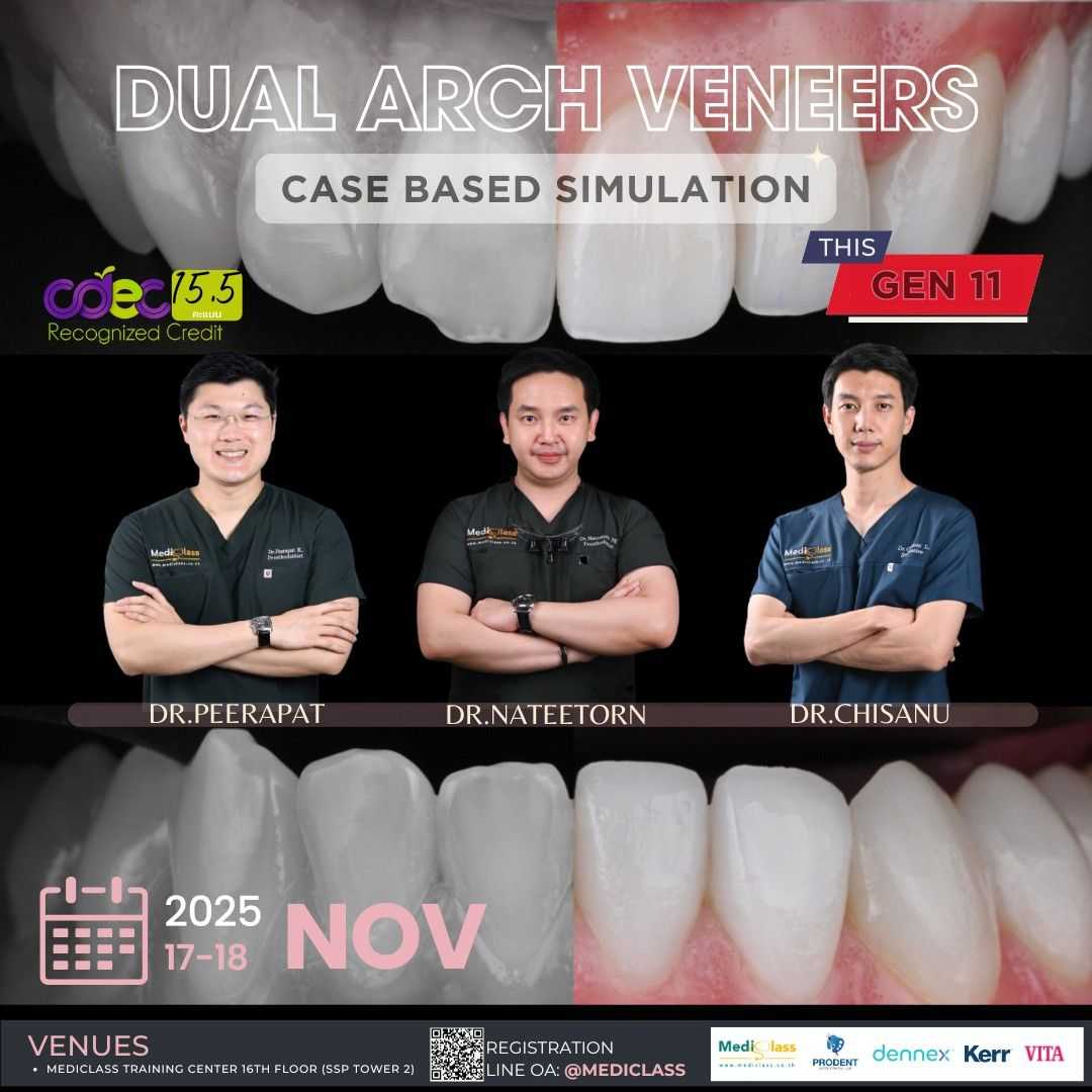 Dual Arch Veneers  Gen 11