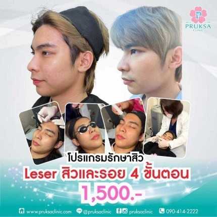 Package Laser สิวเเละรอย  2 ครั้ง (เเถม Mask u มูลค่า 600 บาท)