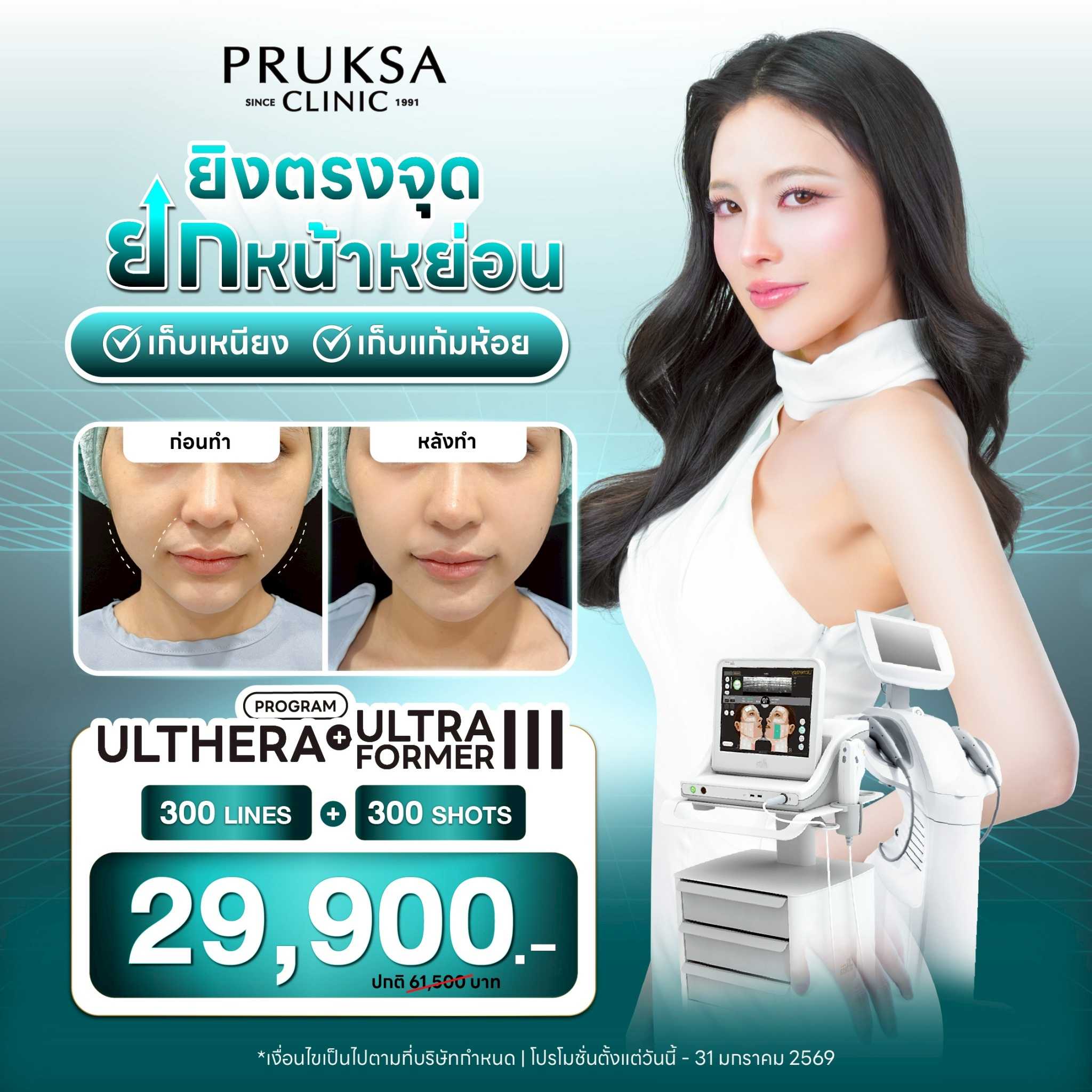 Ulthera 300 Lines + Ultraformer lll 300 shot