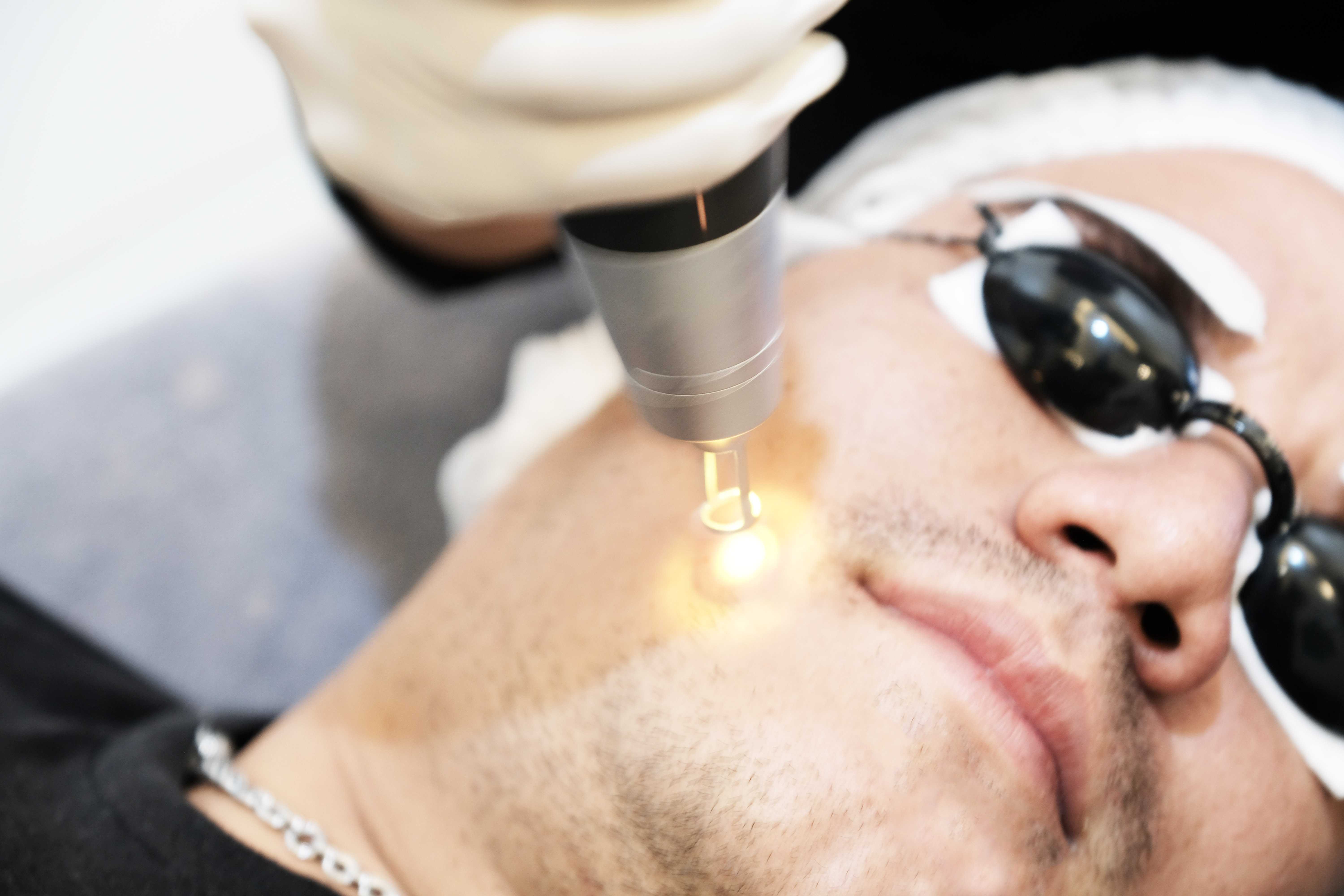 Q-Switch Laser หน้าใส 3 ครั้ง (แถมBluelight 1 ครั้ง)