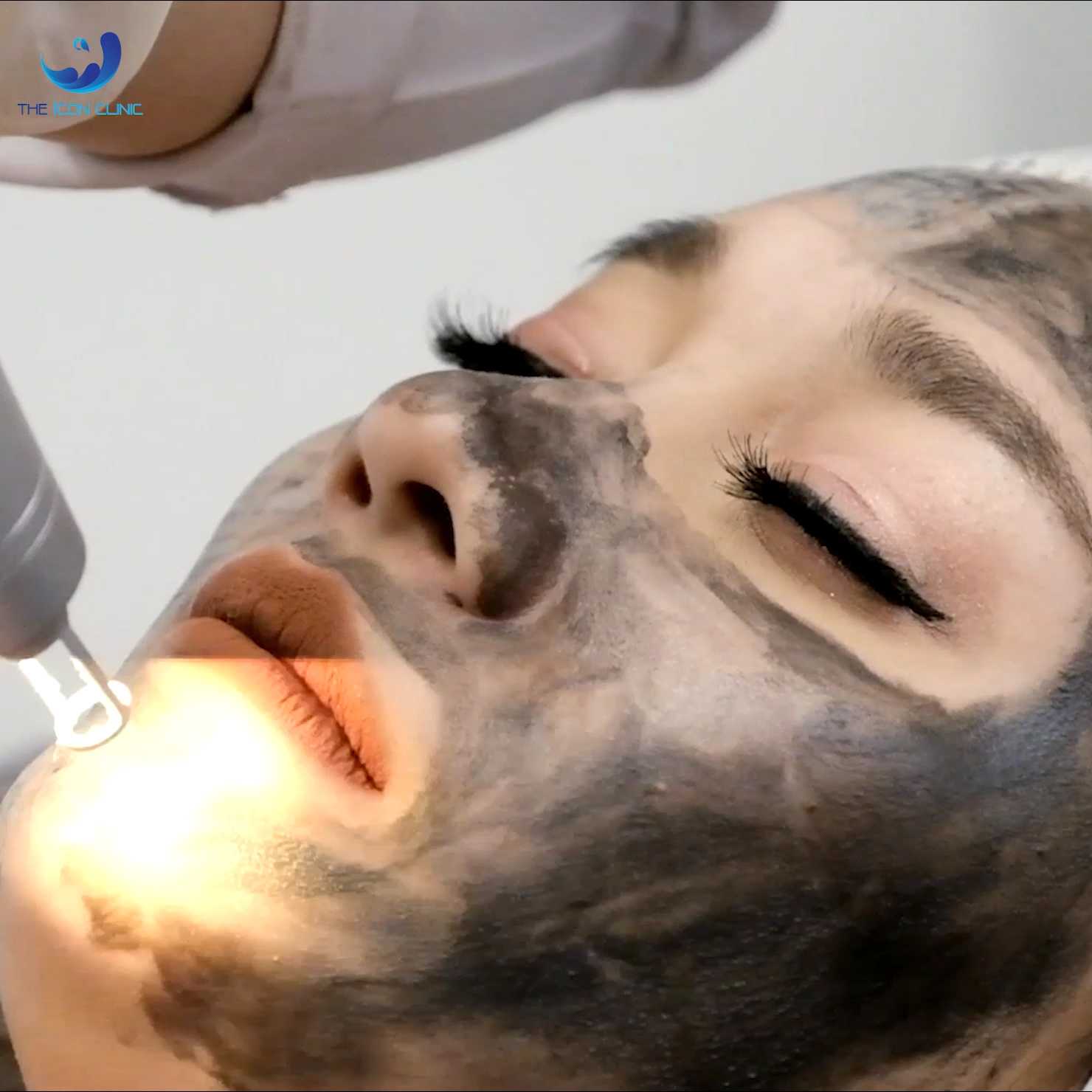 Carbon laser 3 ครั้ง (แถมฟรี 4 รายการ)