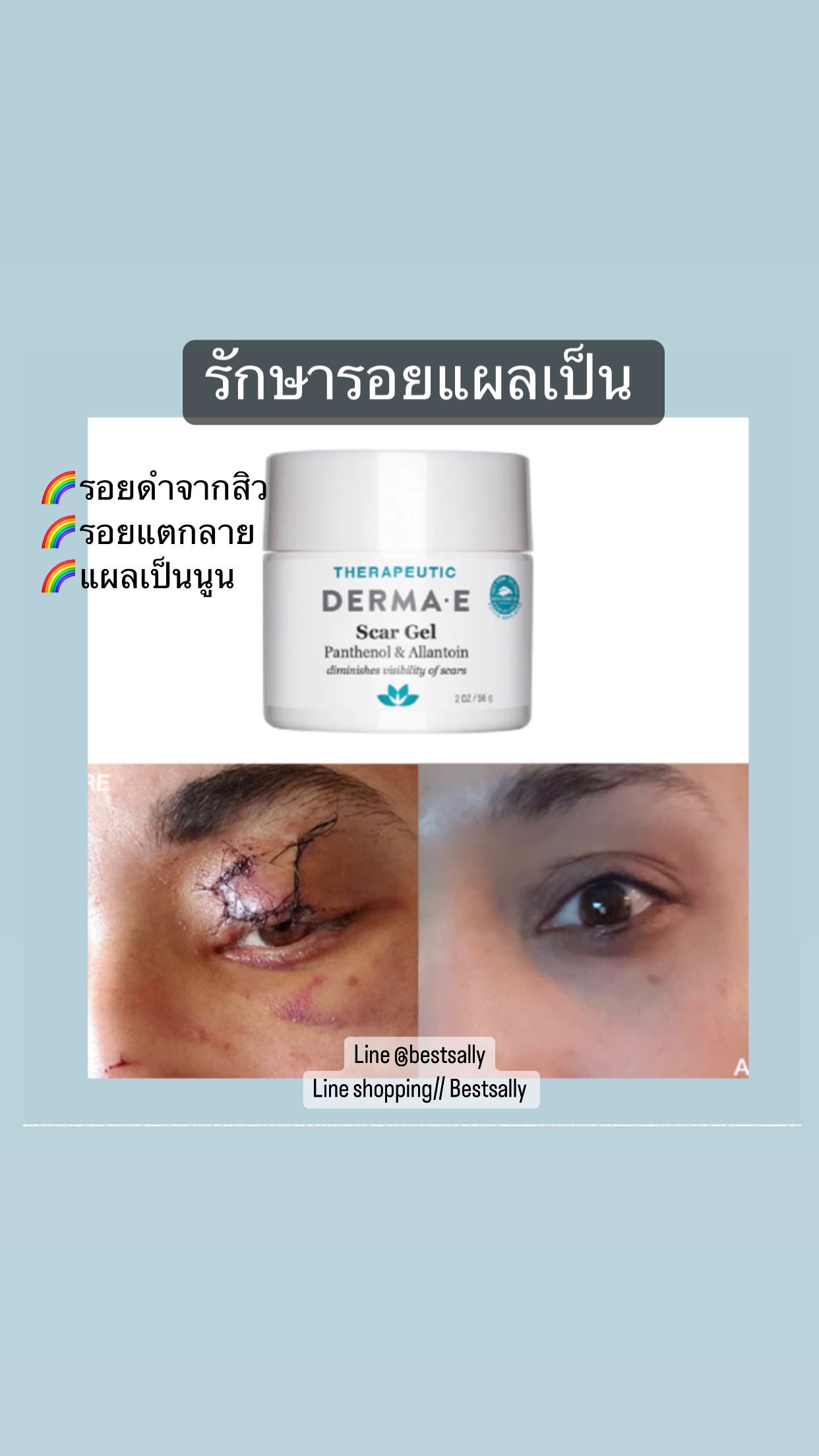 Derma E Scar Gel 56 กรัม รักษารอยแผลเป็น รอยสิว