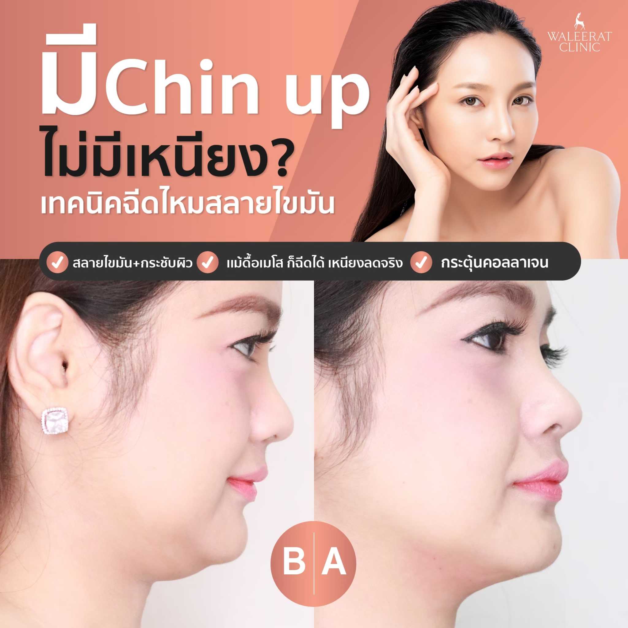 CHIN UP ฉีดไหมสลายเหนียง