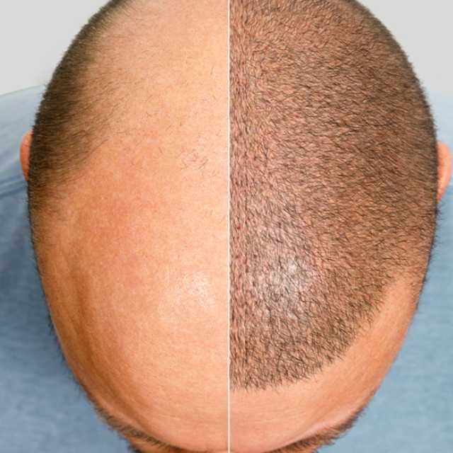 FUE Hair Transplant (1,000 Graph)