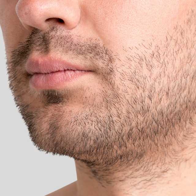 FUE Beard Transplant  (500 Graph)