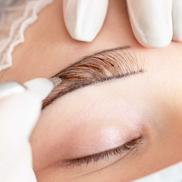 FUE Eyebrows Transplant  (400 Graph)