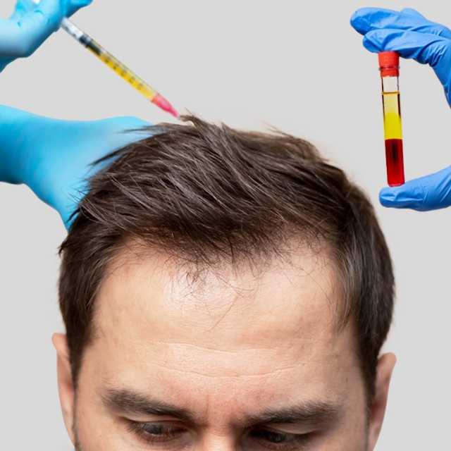 PRP (Platelet Rich Plasma)