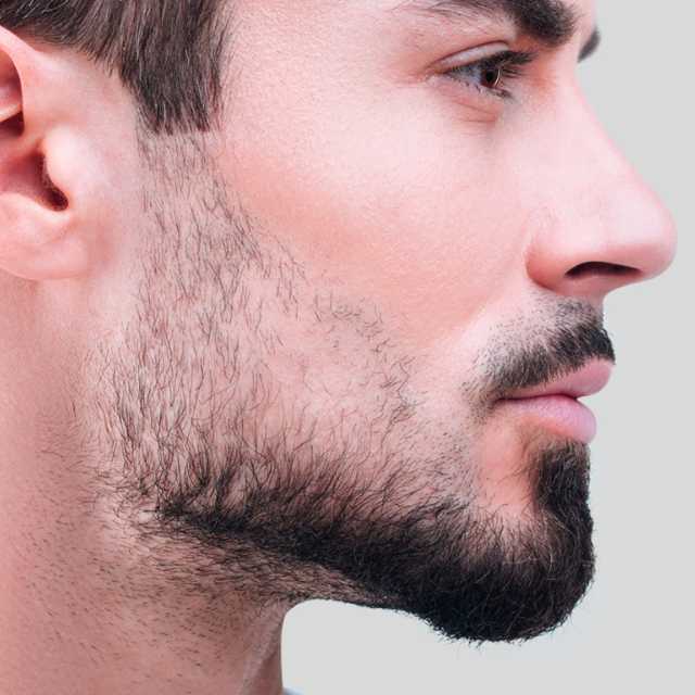 FUT Beard Transplant (500 Graph)