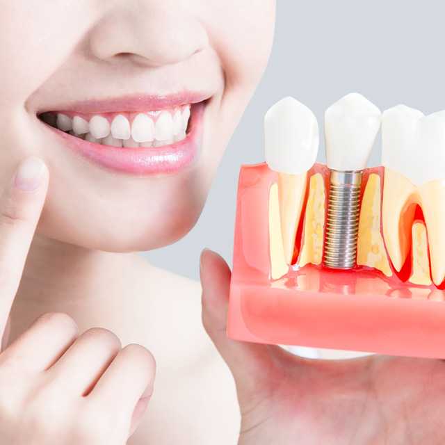 ทำรากฟันเทียม Implant