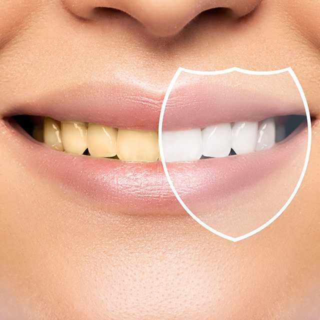 ขูดหินปูน+Polishing+Fluoride