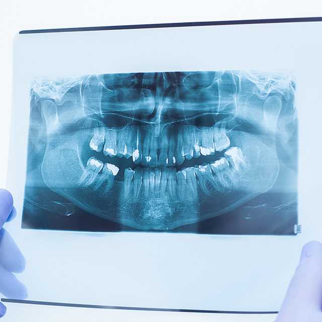 X-ray ฟัน