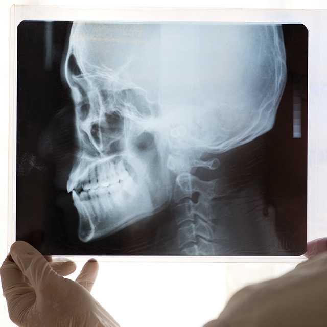 X-ray ขากรรไกร-กะโหลก