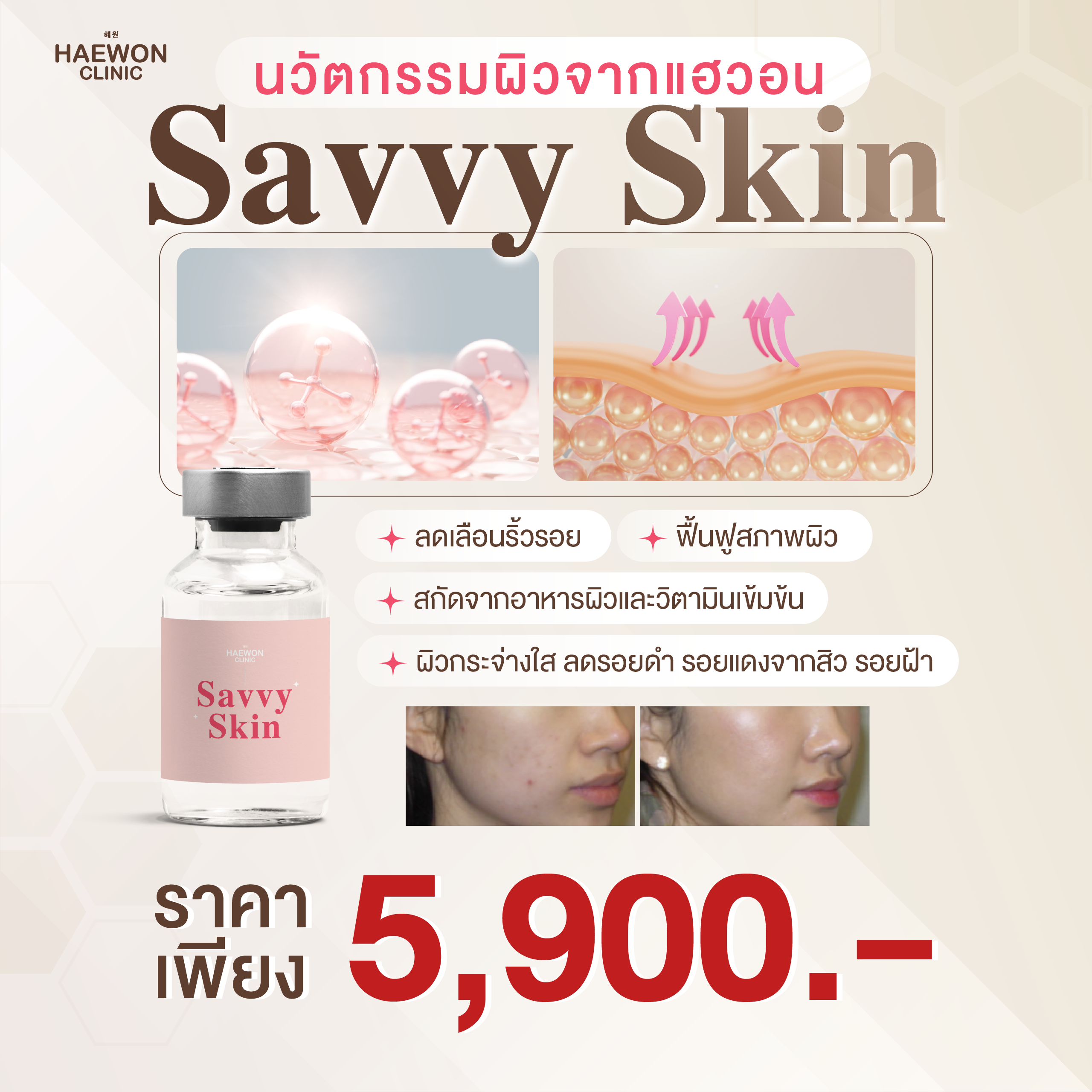 กู้หน้าพัง ให้ปังกว่าเดิม Savvy Skin รูขุมขนแคบลง ผิวหน้าเนียน เพื่อผิวกระจ่างใส จากแฮวอนคลินิก
