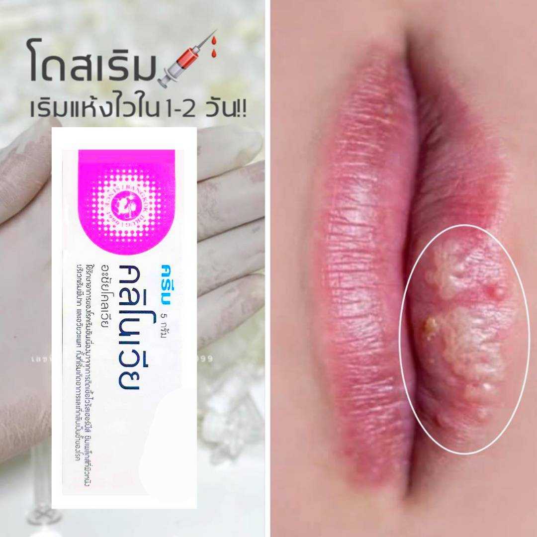 คลิโนเวีย ครีม โรคเริม บริเวณริมฝีปาก อวัยวะทุกส่วน  ส่งด่วน 1วัน ก.ท.ม