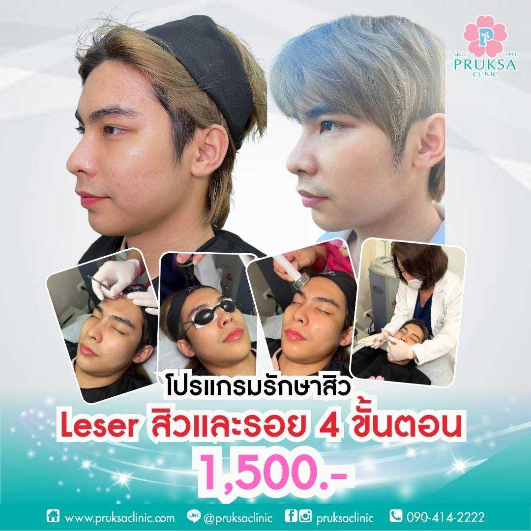 Package Laser สิวเเละรอย 1,500 แถมมาร์กหน้า 1 ครั้ง มูลค่า 600 บาท